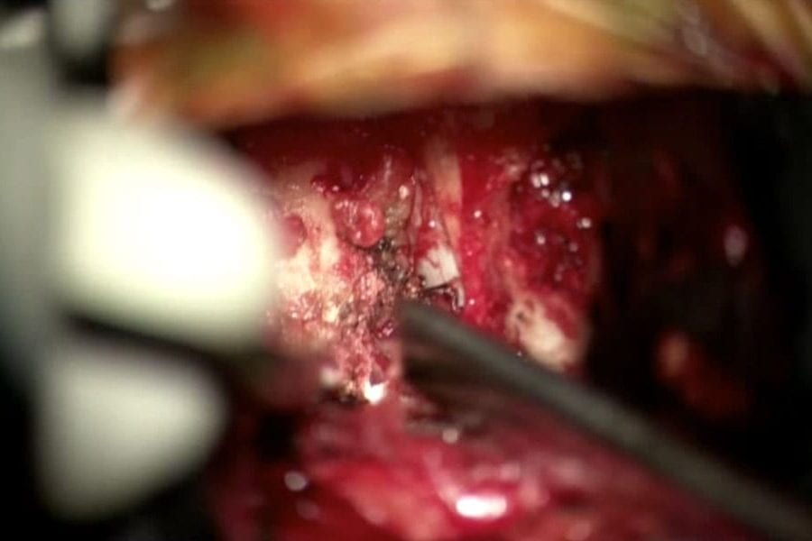 Cervical Discectomy