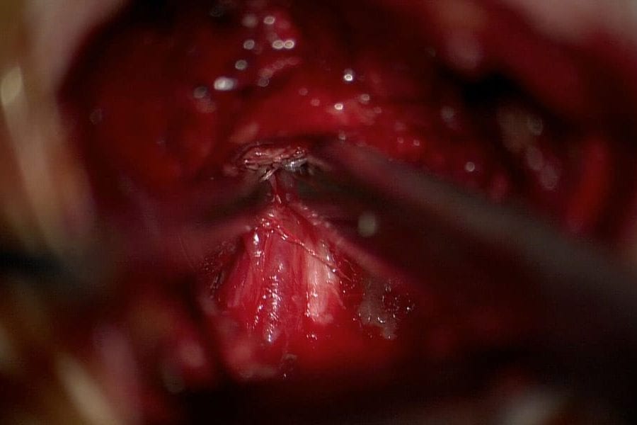Nerve Root Decompression
