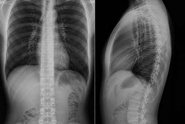 Dr Timothy Steel Radiofrequency in spinal surgery